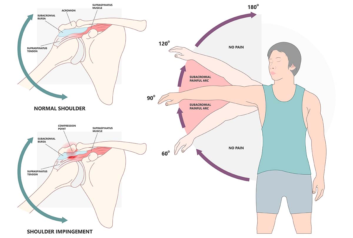 Impingement-Syndrom Eingeklemmte Strukturen zwischen Schulterdach und Oberarmkopf