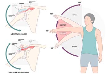 Impingement-Syndrom Eingeklemmte Strukturen zwischen Schulterdach und Oberarmkopf